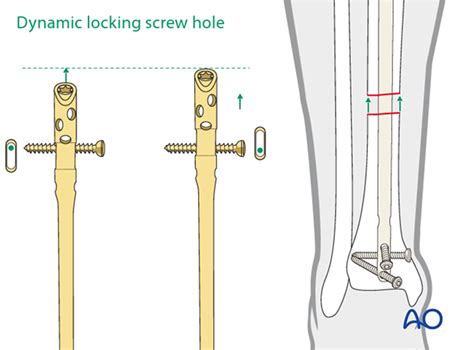 Intramedullary Nailing For Simple Fracture, Spiral, 54% OFF