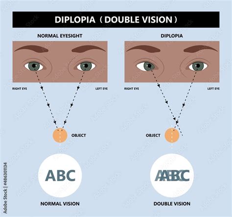 Diplopia: Causes, Symptoms, and Treatment