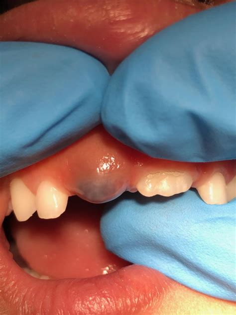 A Purple Blue Bump on Child’s Gum (Eruption Cyst/ Eruption Hematoma ...