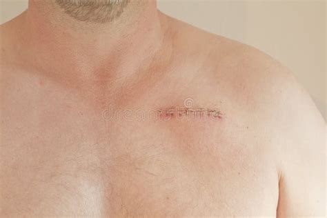 Pacemaker scar stock image. Image of condition, conditions - 25735675