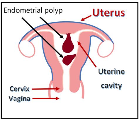 Endometrial polyps – Women's Health by Dr Lee Say Fatt