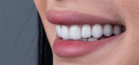 Veneers vs Crowns - What's the Difference? - Village Green Dental Care