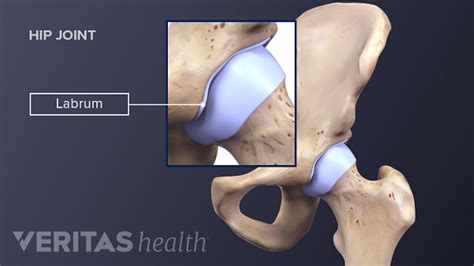 Hip Labrum What's That? - Dr. Michael A. Castillo, MD