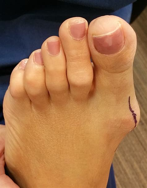 Surgical Correction of Bunions | Podiatric Surgery Centre