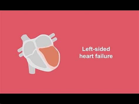 Classifying left-sided heart failure - YouTube