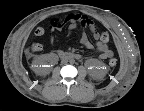 Aesthetic Surgery Gone Wrong: A Case Report and Literature Review of Acute Kidney Injury ...