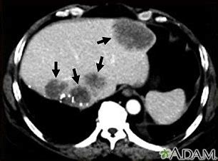 Liver metastases, CT scan: MedlinePlus Medical Encyclopedia Image