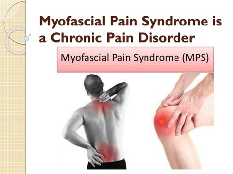 PPT - Symptoms of Myofascial Pain Syndrome & Treatment PowerPoint ...