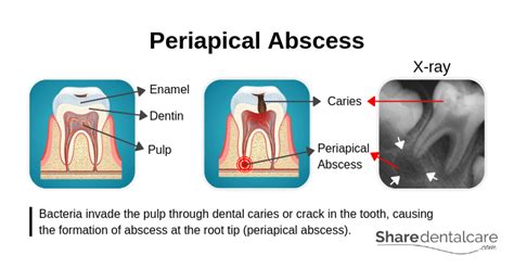 Periapical abscess (Pictures), Symptoms, Causes, & Treatment