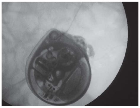 Management Baclofen Withdrawal Syndrome : Colombian Journal of Anesthesiology