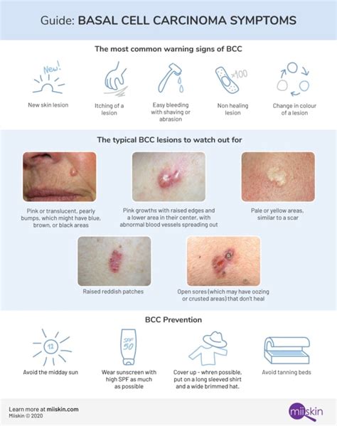 Basal Cell Carcinoma - Symptoms, Types and Pictures