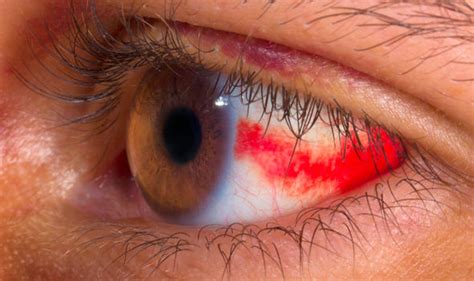 High blood pressure symptoms: Blood spots in your eyes could be a tell-tale sign | Express.co.uk