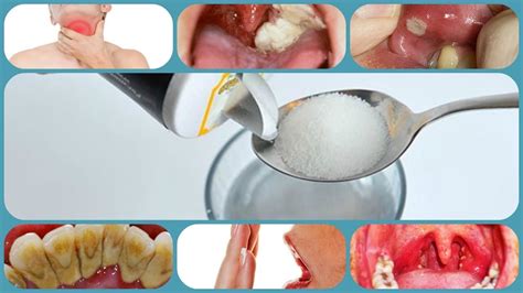 Salt Water Gargle: Amazing Benefits You Won’t Believe. | Dental surgery, Dental rinse, Dental ...