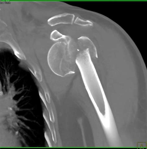 Fracture Dislocation Left Shoulder with Humerus Fracture and Glenoid Fracture - Musculoskeletal ...