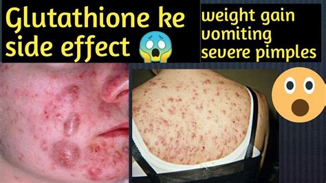 Glutathione Deficiency