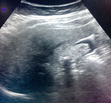 Ultrasound liver demonstrating a lesion inside the gallbladder. | Download Scientific Diagram