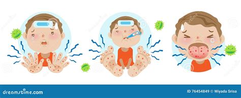 Infected Children. Enterovirus. Hand-foot-mouth Disease Infographics ...