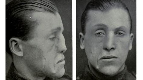 Innovative Cosmetic Surgery Restored WWI Vets' Ravaged Faces—And Lives ...