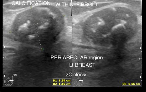 Fibroadenoma of Breast | Sono Scan 5D