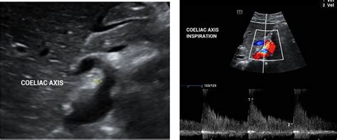 -(A): Ultrasound Abdomen image shows the origin of celiac artery from... | Download Scientific ...