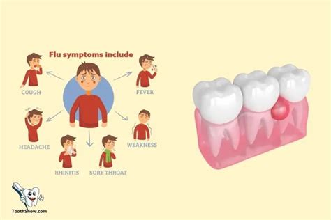 Can A Tooth Abscess Cause Flu Like Symptoms? Yes!