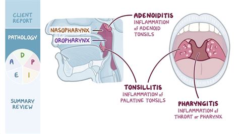 Bacterial Tonsillitis Vs Viral Tonsillitis