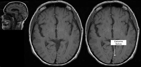 Radiological Anatomy: Calcarine Sulcus - Stepwards