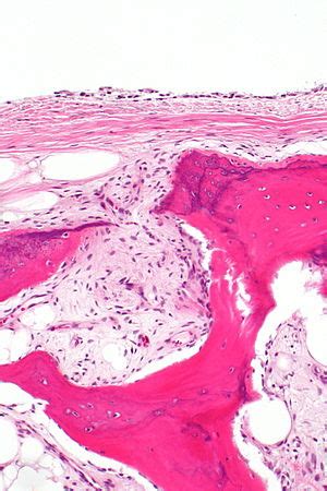 Synovial chondromatosis - Libre Pathology