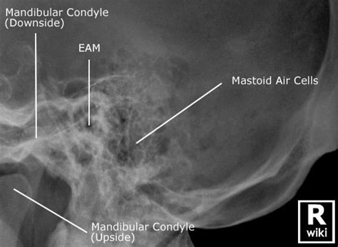 Mastoids Radiographic Anatomy | Medical radiography, Radiology imaging, Medical knowledge