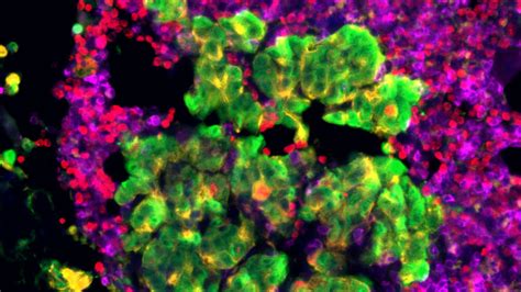Onalespib Blocks mRNA Splicing of Androgen Receptor Variant 7 in Prostate Cancer (Medicine ...