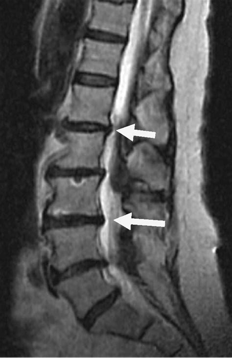 How To Read An Mri For Herniated Discs Cause Of Sciatica The | Hot Sex Picture