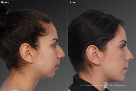 Pin by Lindsay Traylor on beauty tips | Chin implant, Rhinoplasty, Chin augmentation