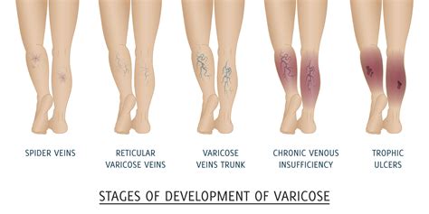 Best Essential Oils and Recipes For Varicose Veins Treatment | Essential Oil Benefits