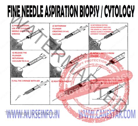 FINE NEEDLE ASPIRATION BIOPSY/CYTOLOGY - Nurse Info