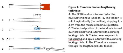 AAHS - The Effect of ECRB Tendon Lengthening on PT to ECRB Tendon Transfers: a Biomechanical ...