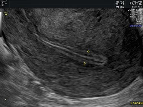 Management of thin endometrium in assisted reproduction: a clinical practice guideline from the ...