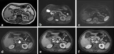 Frontiers | Pancreatic Leiomyosarcoma With Schistosomiasis Hematobia: A Case Report and ...