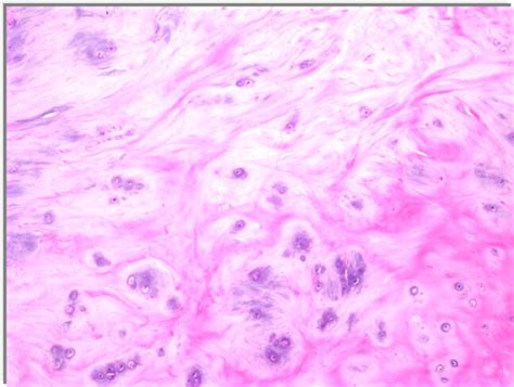 Synovial Chondromatosis - Pathology - Orthobullets