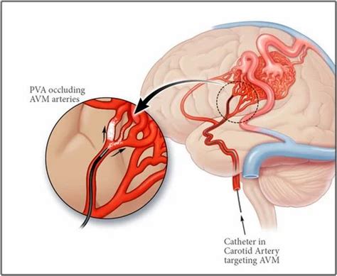 AVM Embolization Treatment in Mumbai | ID: 7982909255