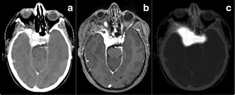 Imaging of a typical skull base meningioma on a contrast-enhanced CT, b ...