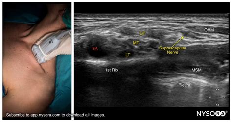 Technique: Suprascapular nerve block - NYSORA Regional Anesthesia App