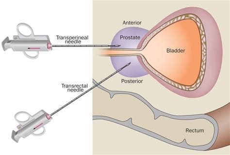 Transperineal Prostate Biopsy. A biopsy of the prostate gland is… | by Dr Chui Ka Lun 崔家倫醫生 | Medium