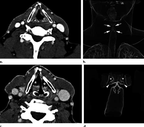 Larynx Ct Scan