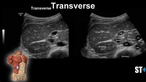 Liver Anatomy and Protocol basics – Sonographic Tendencies | Liver ...