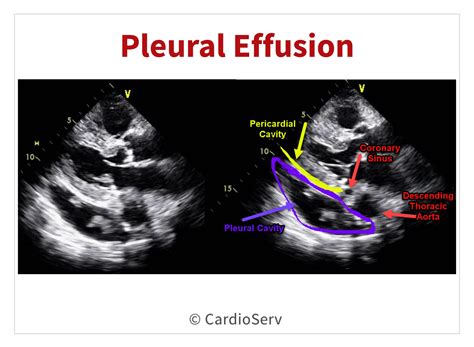 Myocarditis Vs Pericarditis - Complications of pericarditis | General center ... - Spann Orne1996