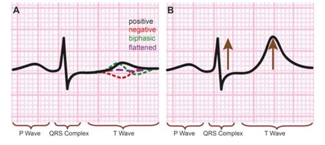 The Deflection Waves in an Ecg Tracing Include