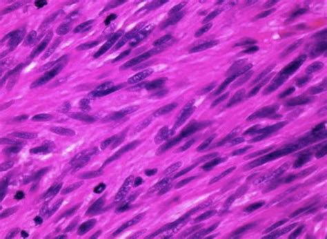 Soft Tissue Sarcoma - Pathology - Orthobullets