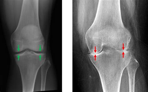 Types & Symptoms of Knee Arthritis | David Slattery