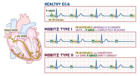 Second Degree Heart Block - How Heart Starts Skipping Beats