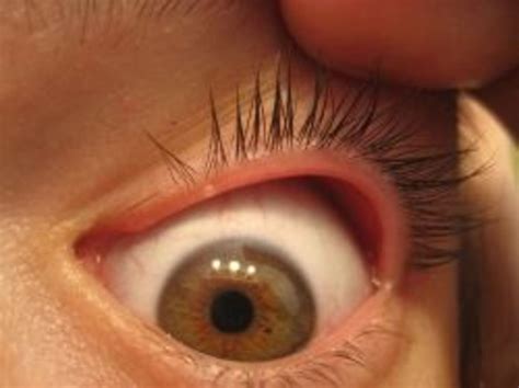 Do You Have Itchy Red Eyelids? | HealDove